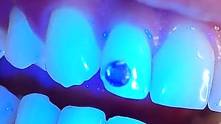 Complete Teeth Exam by the Dentist, Installation of Jewelry