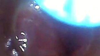 Endoscope POV: Test Tube Cock Urethral Insertion
